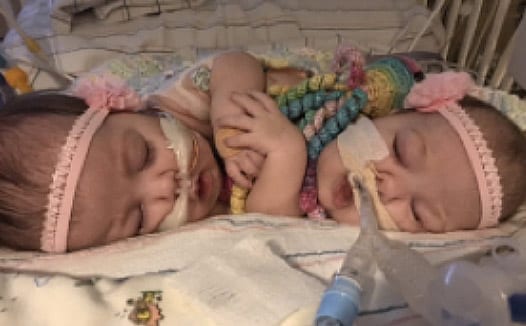 Conjoined Twins Separated by UF Health Surgeons Will Be Together for Christmas