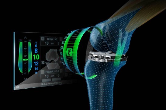 Smart Solution Aims to Improve Patient Outcomes and Satisfaction for Total Knee Replacement