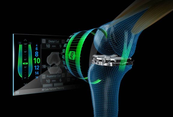 Smart Solution Aims to Improve Patient Outcomes and Satisfaction for Total Knee Replacement